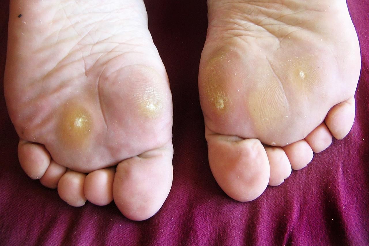 درمان زگیل کف پا با اسید سالیسیلیک