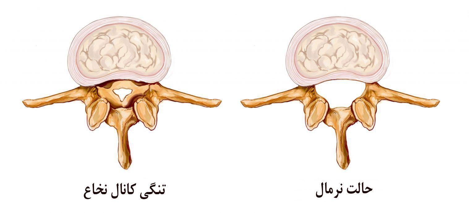 عوارض تنگی کانال نخاعی