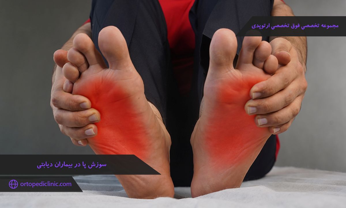 سوزش پا در بیماران دیابتی
